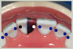 Mx Intercuspation Mx Central Incisors.png